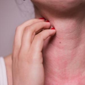 Mulher com pele vermelha no pescoço por causa das alergias